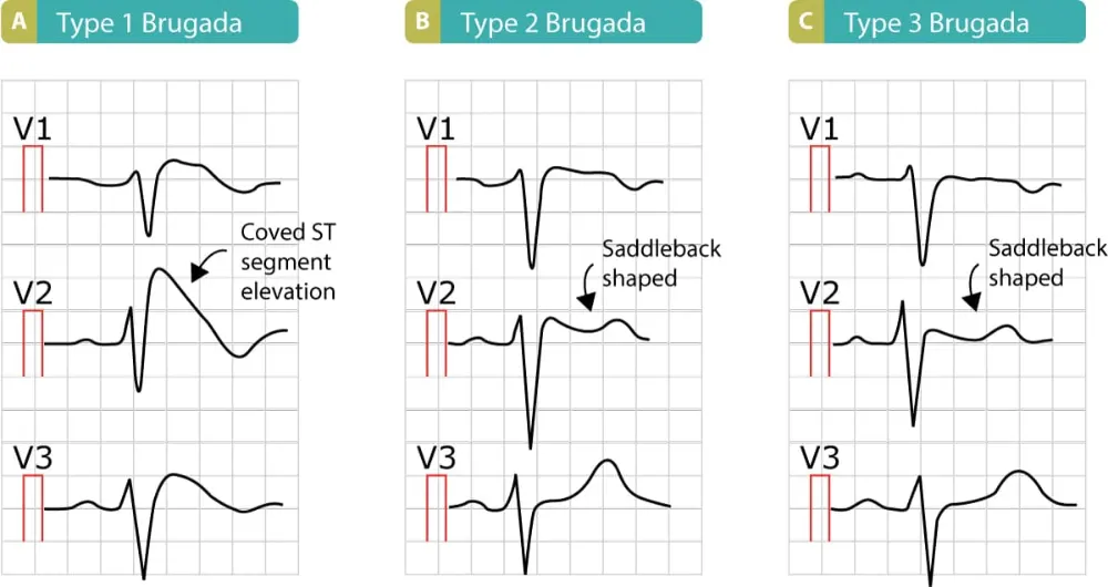 Rappresentazione delle tre tipologie del pattern di Brugada.