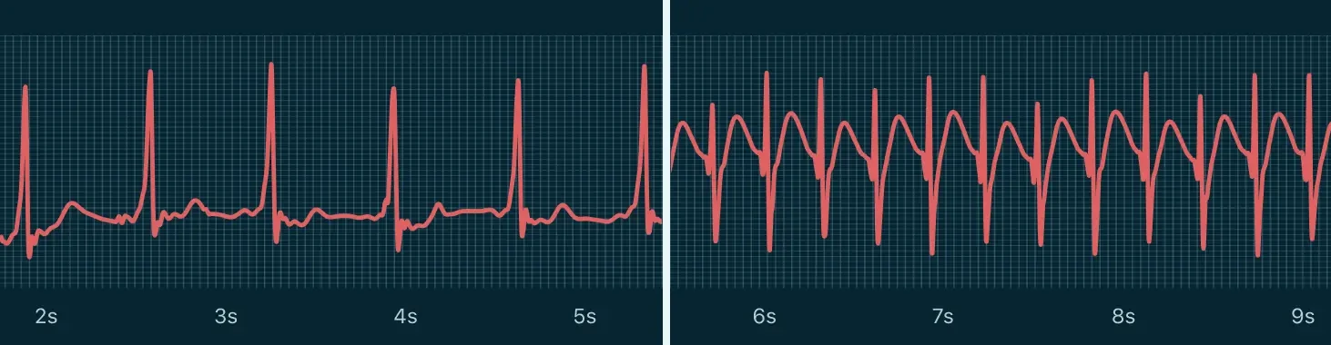 Tracciato elettrocardiografico con aritmia.